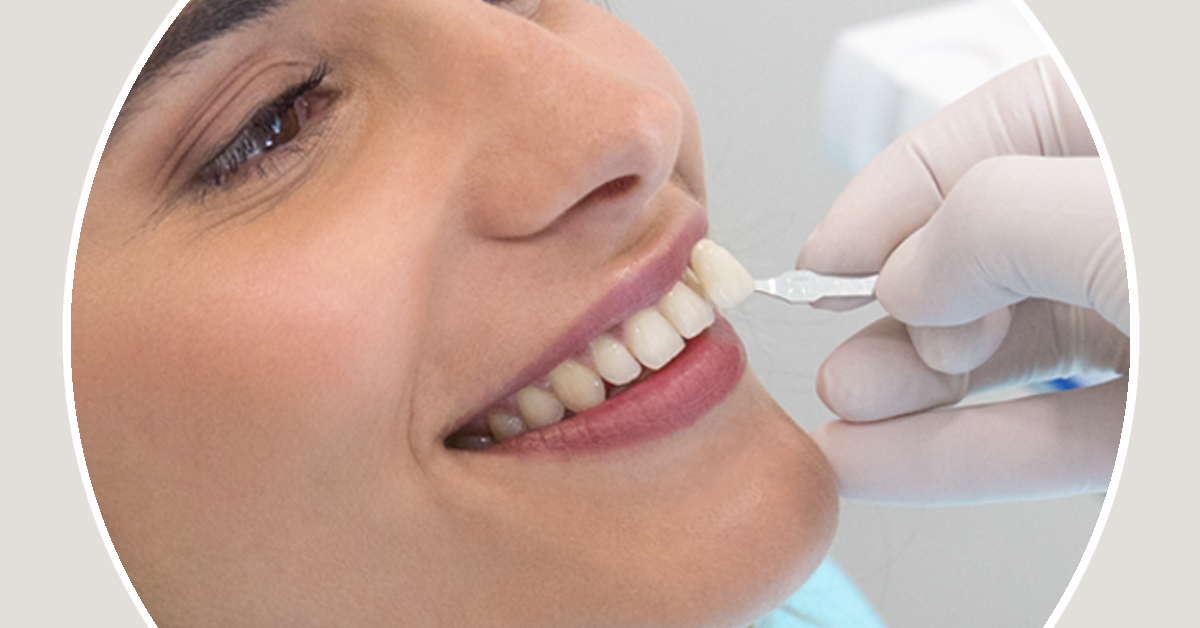 Facetas dentárias