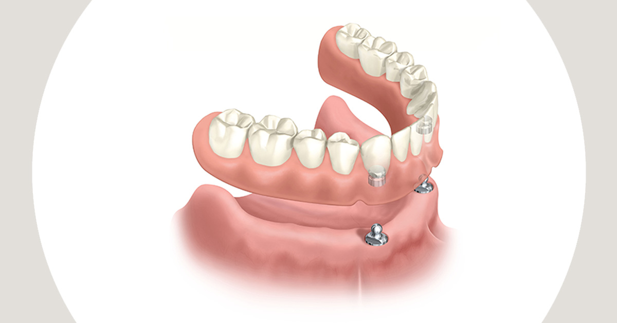 Próteses dentárias